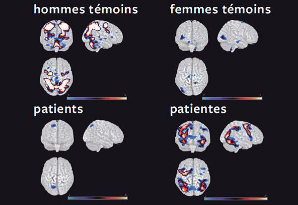 Imagerie par résonance magnétique fonctionnelle de l'activité cérébrale
