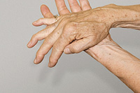 arthritic hands